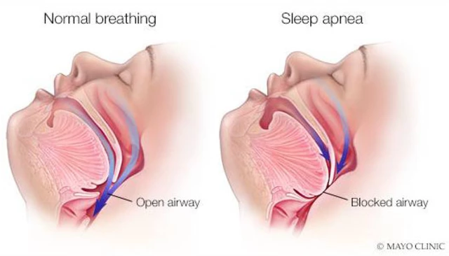 The Link Between Sleep Apnea and Heart Rhythm Disorders