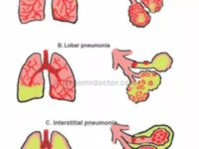 The Role of Ampicillin in the Fight Against Pneumonia